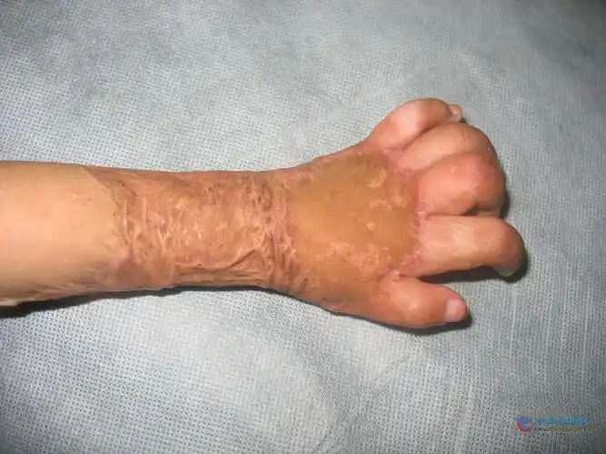 烧伤一年半后,求教