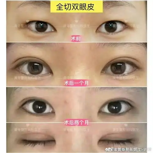 刘玲医生案例超话衡量双眼皮成功的指标:  1.形状,2.宽度,3.