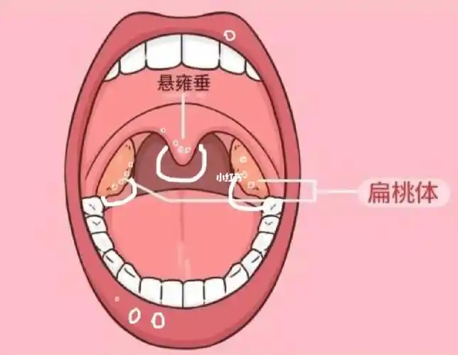 小勺子挪开悬雍垂看到的)喷药还喷不到好疼啊还伴随着咳嗽#口腔溃疡