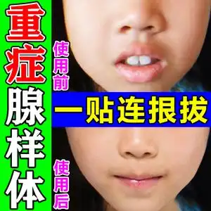 【包冶】儿童腺样体肥大面容矫正器鼻塞呼噜嘴呼吸中药调理保健贴