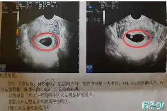 孕囊形状看男孩女孩孕囊大小看胎儿性别孕囊b超单图解