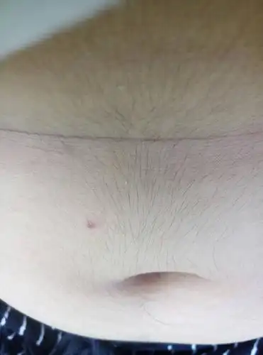 又怎么能让这毛消失?这几天多了很多.如果不小心让人看到很