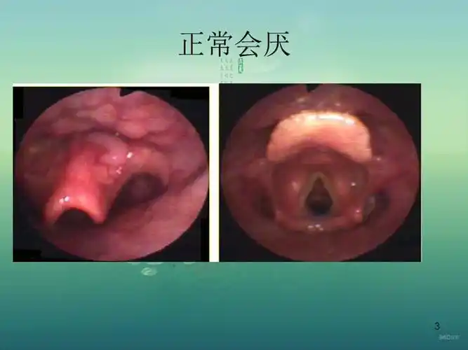 急性会厌炎的护理ppt参考幻灯片