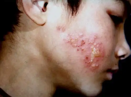 单纯疱疹 - 好大夫在线