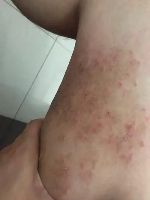 这是我腿上起的一片,症状是特别痒,还有小疙瘩,一开始一小片,后来越抓