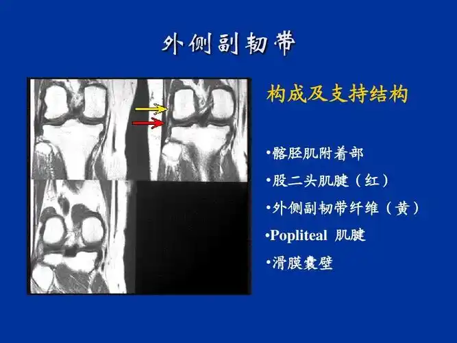 外侧副韧带 构成及支持结构  髂胫肌附着部  股二头肌腱(红)  外侧副