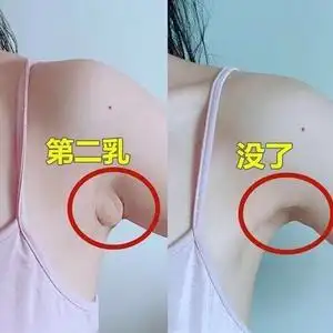 【小红书同款 10天副乳拜拜】去掉消除贴收神器腋下结节疏通淋巴