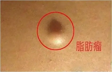 全身多发脂肪瘤患者要求手术切除医生却拒绝为什么