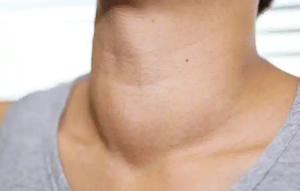 甲状腺发病前的3大点赵萍医生当身体出现反常现象要注意