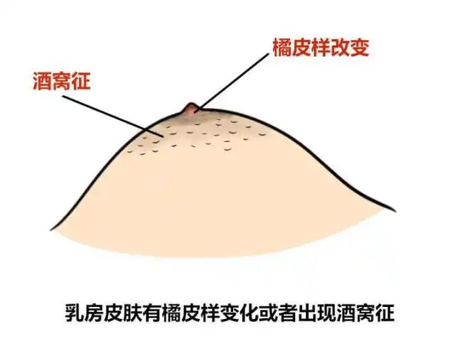 远离"女性杀手"乳腺癌