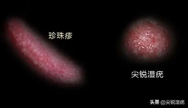 珍珠疹表现为局部表面光亮,透明或者呈皮肤颜色淡红色的增生物,一般几