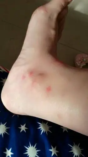 哎!痒的好难受(╯﹏╰)这到底是什么疙瘩啊