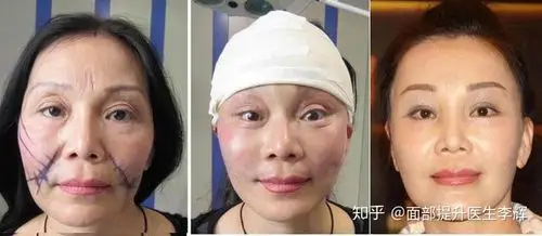 拉皮除皱手术到底有多疼听听这位姐妹的感受分享