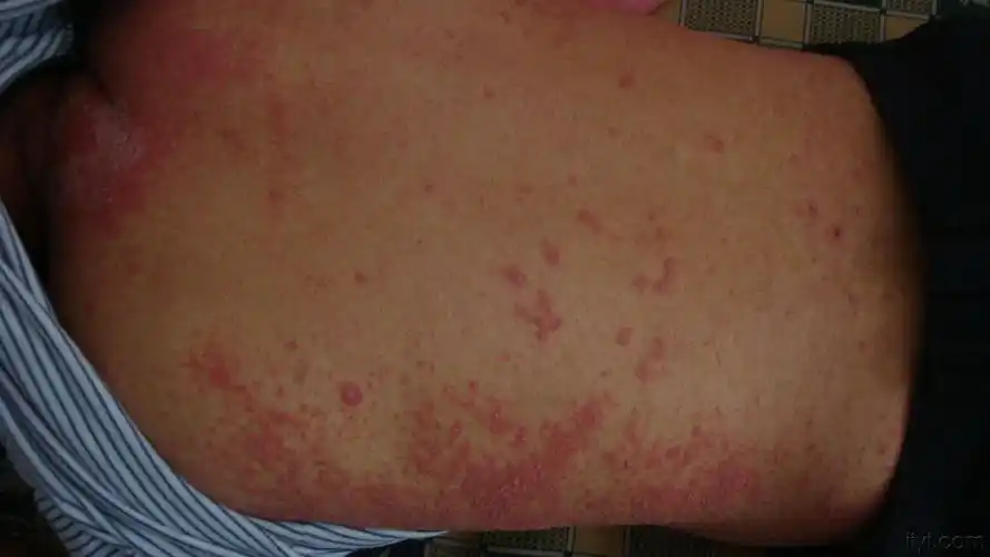 腹股沟以上的皮肤病变,请诊断