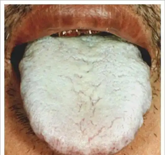 临床常见舌照高清图