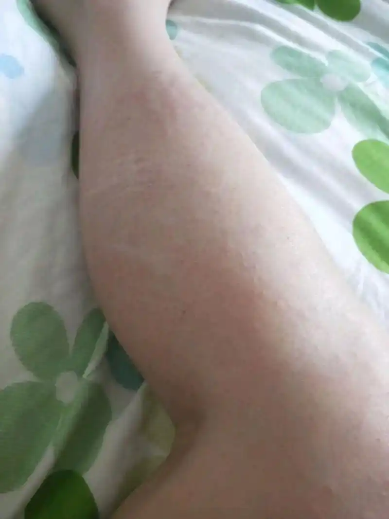 这个荨麻疹天天发,只要一热就发,空调房里都不行,医生开的药也吃了炉