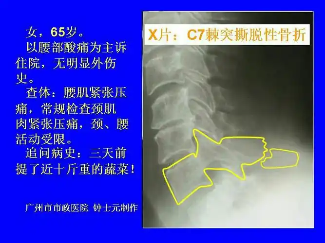 医疗安全 一一第7颈椎棘突撕脱性骨折