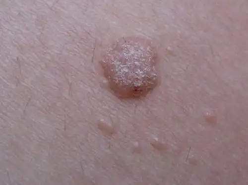 瘤病毒引起的一种常见皮肤病,是一种常见的病毒性赘生物,中医称"疣目"