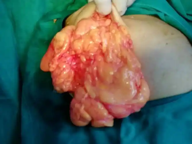 官店分院成功实施首例腹壁脂肪瘤切除术