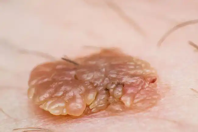 感染hpv应该怎么办hpv症状如何治疗和预防