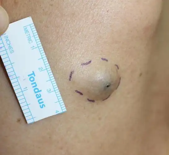 可不予处理,对于体积较大,有压痛等不适症状的脂肪瘤可选择手术切除