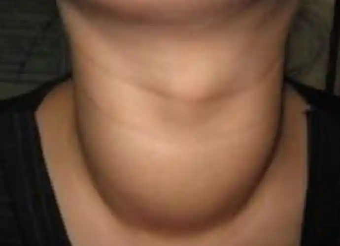 甲亢不是小问题,别光顾着"大脖子"