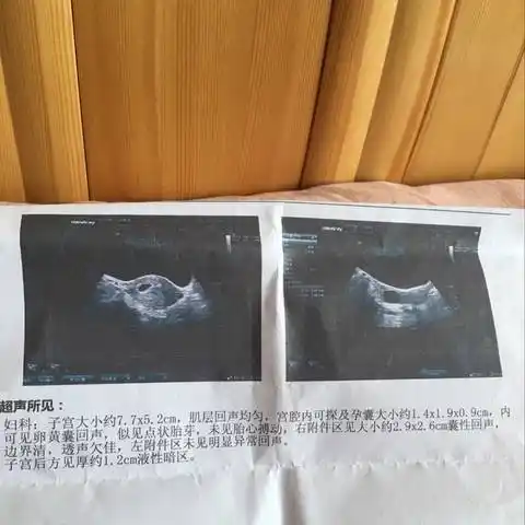 超实用:看孕囊形状知男女