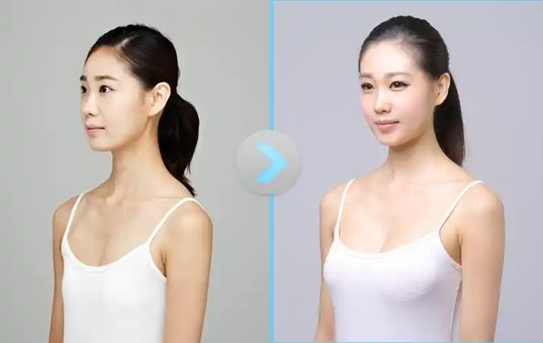 首页 案例日记 真人案例            华美内窥镜极速动感丰胸,是借助