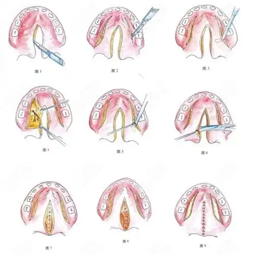 唇腭裂手术治疗过程