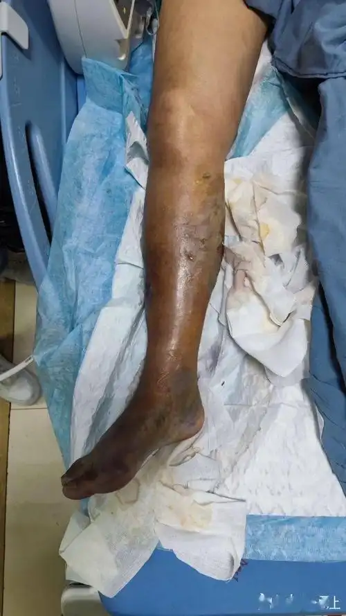 宁波阿姨海边玩一下午,第4天被截肢!医生:致死率很高,最近连遇3例_海