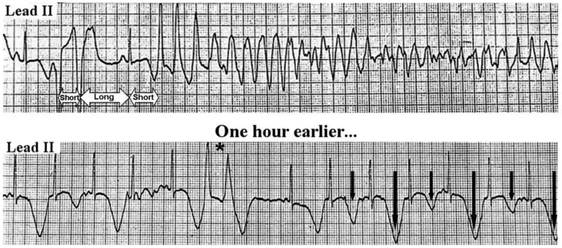 长qt综合征是心电图上出现qt间期延长,临床上出现为心悸,心脏骤停