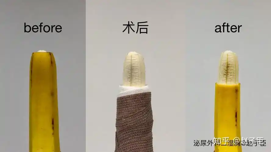 包皮手术后或许你会想知道的