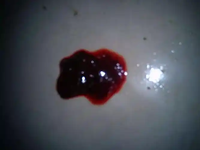 其实,如果大便有血的话,无论是什么颜色,鲜红,甚至浓黑,都应该引起