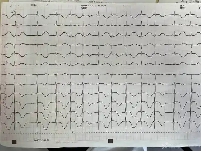 患者女性80岁急性非st抬高型心肌梗死心电图