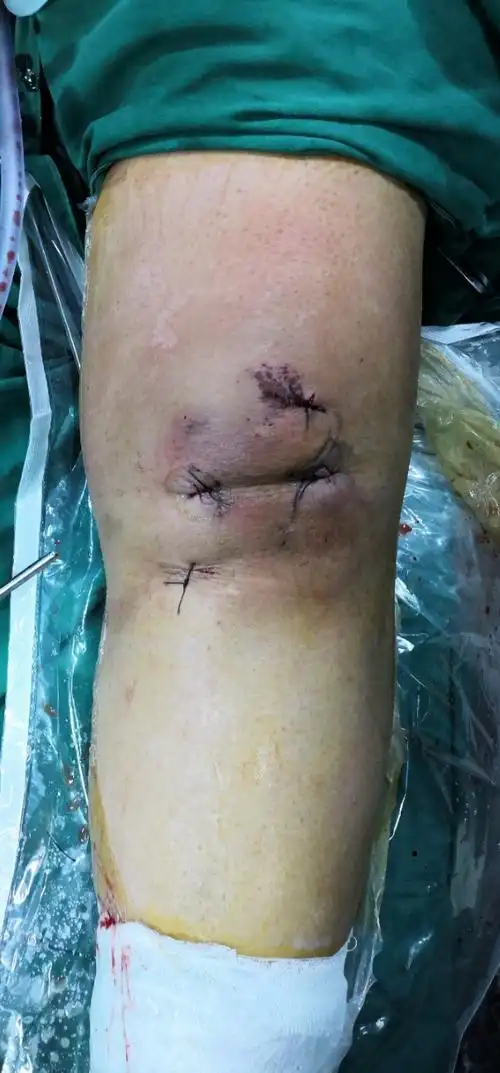 胫骨髁间棘撕脱骨折关节镜下固定一例