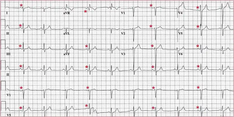 心电图分析电轴右偏是何原因需要治疗吗
