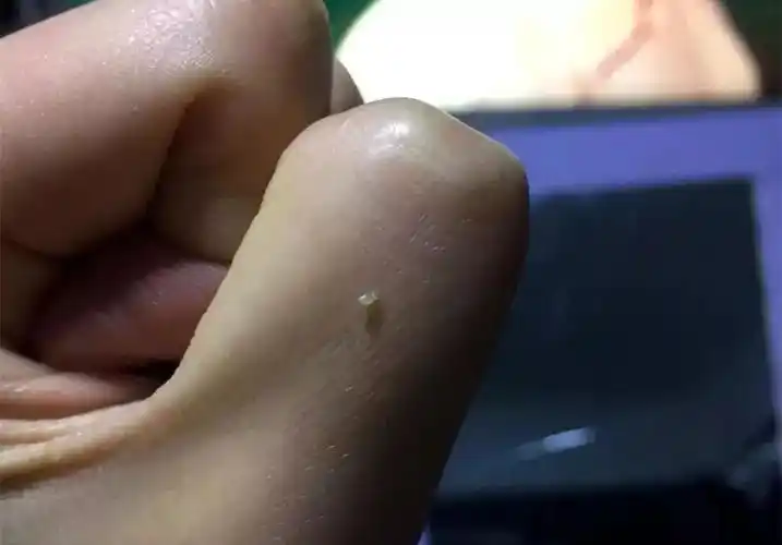 谈谈脂肪粒这个恼人的小妖精