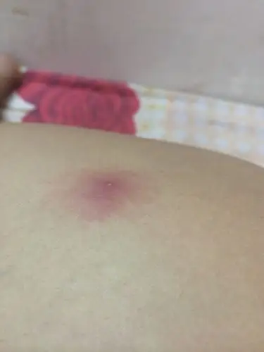 大腿根长了个这个,一压挺疼的,能挤吗