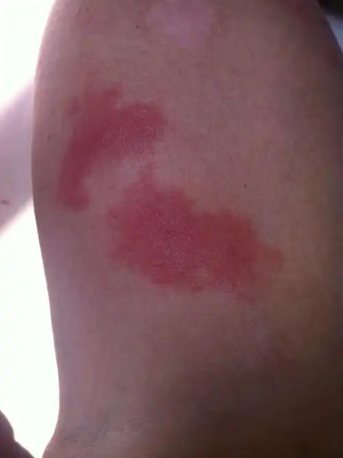 家了出了一种像蚂蚁的小虫,咬人后刺痛,上网百度了一下说是肿腿蜂,求