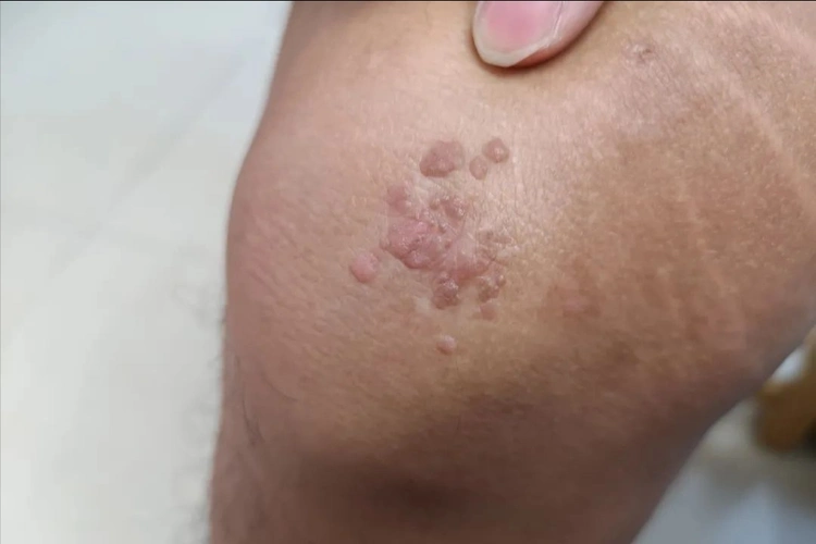 hpv和病毒疣啥模样