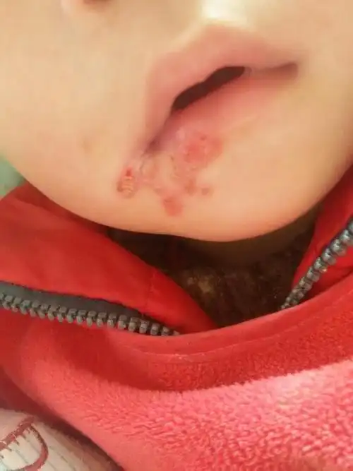 求助,宝宝嘴巴上面长了好多水泡一样的包,应该怎么办?