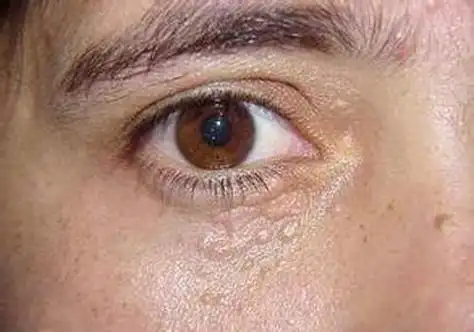 眼部扁平疣怎么去除