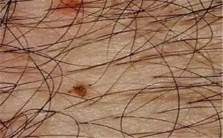 怎么确认是阴虱