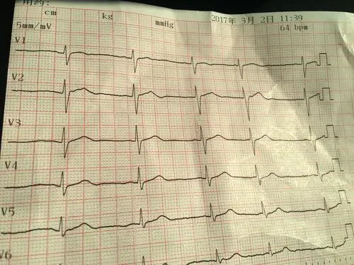心电图分析患者头晕手脚出汗