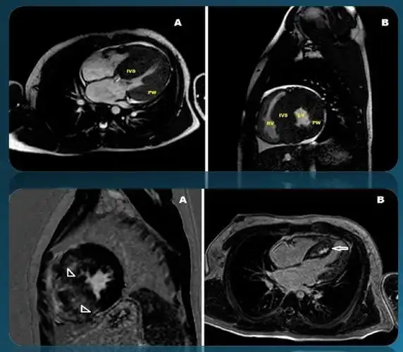 【才俊讲堂】孔令秋:左心室肥厚的诊断方法