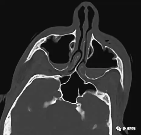 【急诊】颧骨骨折,上颌骨骨折ct表现
