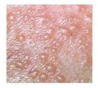 感染了生殖器疱疹会带来哪些危害_生殖器疱疹_症状_症状表现 - 好大夫