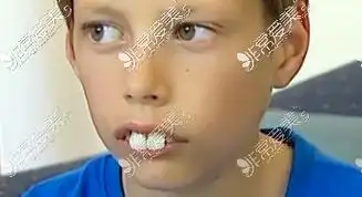 九岁孩子龅牙矫正方法听听专业牙医怎么说