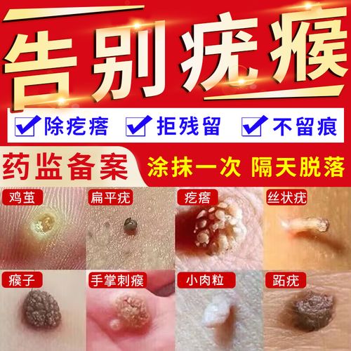 去疣祛疣去扁平疣瘊子专用去除特效去脖子上的小肉粒神器药膏lh