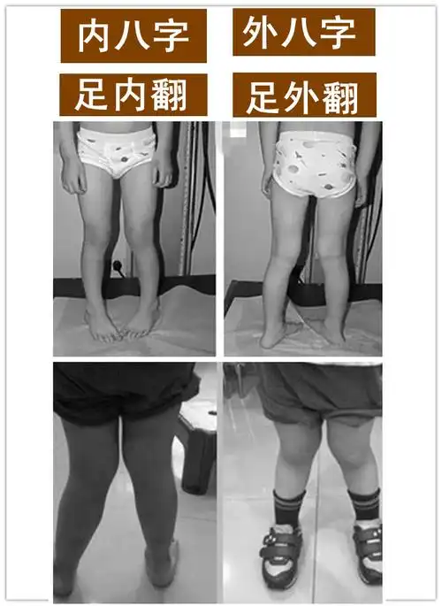 一岁半宝宝内八字,宝宝3周岁了走路内八字,怎